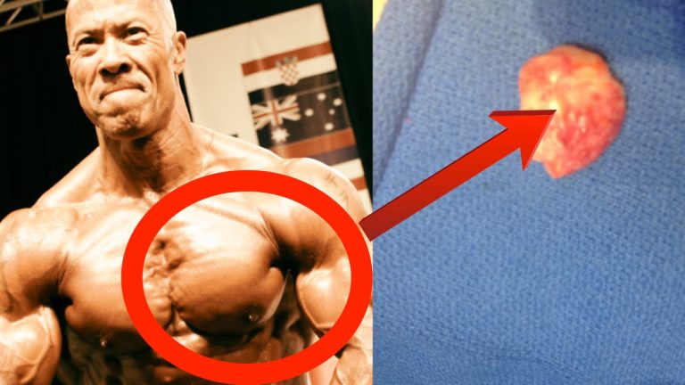 Vücut Geliştirme ve Steroid Kullanımı ile İlgili Bütün Olumsuzluklar