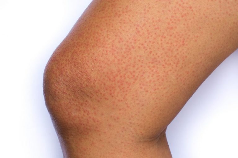 Kollarınız Pütür Pütürse Vitamin ve Mineral Eksikliğiniz Olabilir!