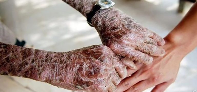 DNP Adlı Yağ Yakıcıyı Kullandı ve Öldü!