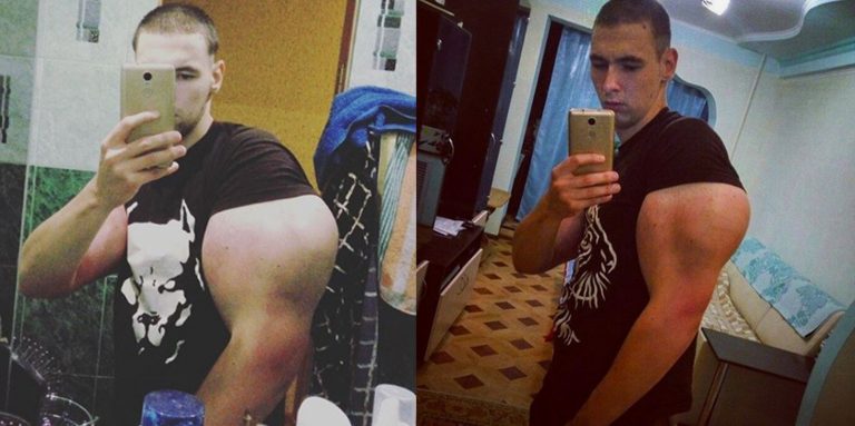 Rus Sporcu Sonunda Kol Kaslarındaki Maddeleri Boşalttırdı mı?
