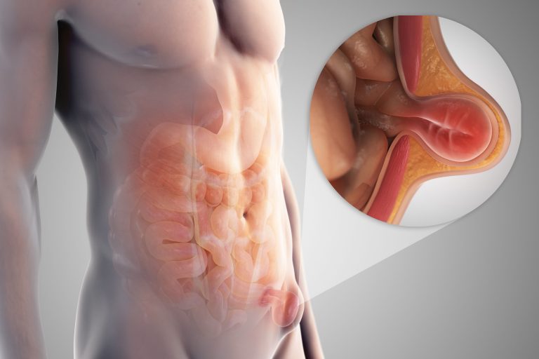 Spor Yaparken Kasık Ağrısı Yaşıyorsanız Dikkat Etmeniz Gerekenler Var!