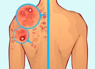 Spora Başladıktan Sonra Oluşan Sivilceler Nasıl Geçer? fitness sivilce yapar mı?